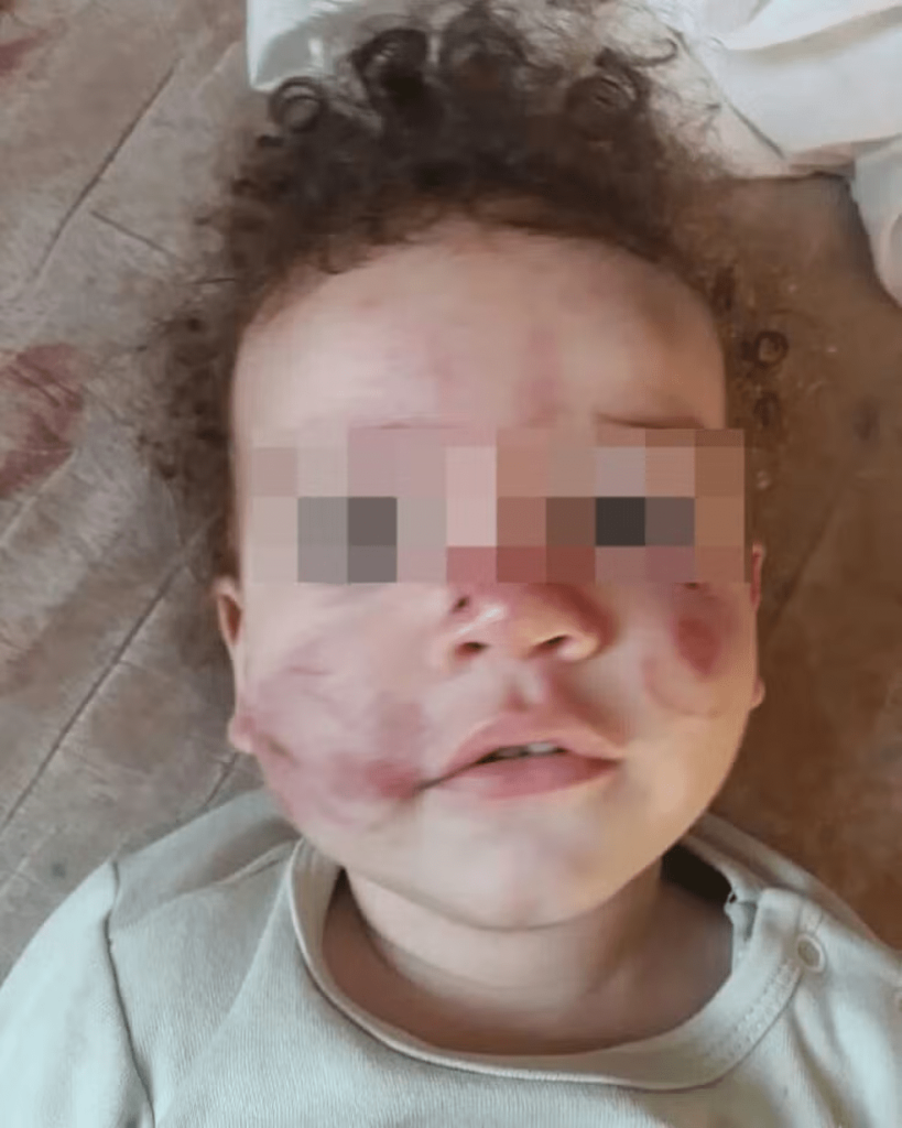 Mãe faz denúncia após bebê voltar de creche com rosto machucado em Bom Despacho - Foto: redes sociais