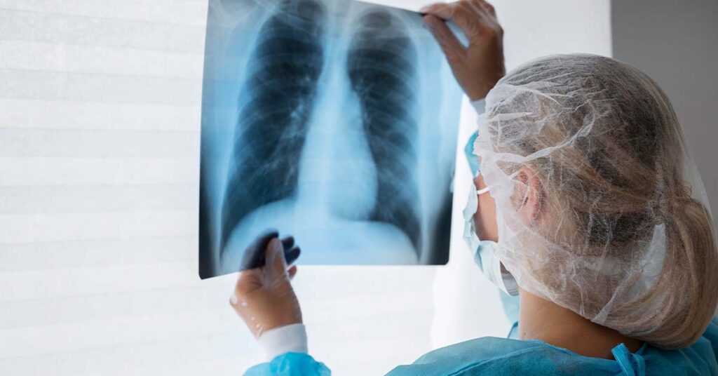 Anvisa aprova medicamento para câncer de pulmão que reduz morte em 76% - Foto: reprodução