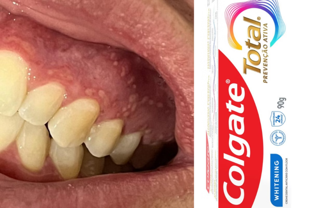 Anvisa interdita linha de cremes dentais da Colgate após lesões bucais em consumidores - Fotos: reprodução